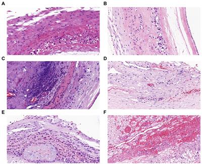 The role of upper and lower genital tract microbiota alterations in term chorionamnionitis: A prospective study